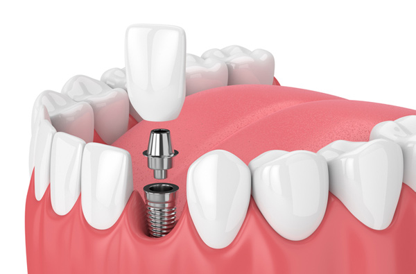 Уход за зубными имплантатами